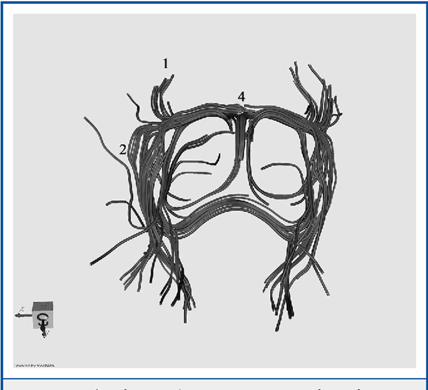  Three-dimensional magnetic resonance rendering demonstrates a superior view of the anterior commissure (AC). 1: anterior limb of the AC; 2: lateral (temporal) limb of the AC; 4: corpus of the AC. 