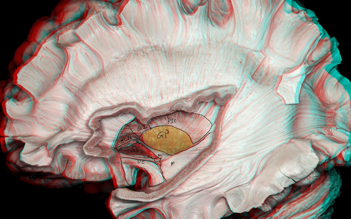 GP: Globus pallius; A, G, PIC: Anterior, Genu and Posterior limb of internal capsule; AC: anterior commissure; UC: uncinate fasciculus; SI: substantia innominata