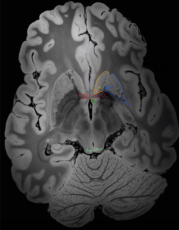 Anterior commissure
Caudate nucleus
Column of fornix
Putamen