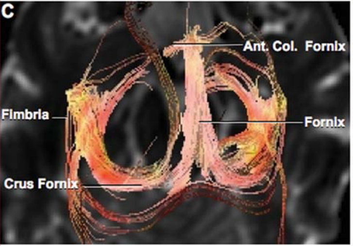 Axial view: Bilateral tractographic reconstruction of the fornix