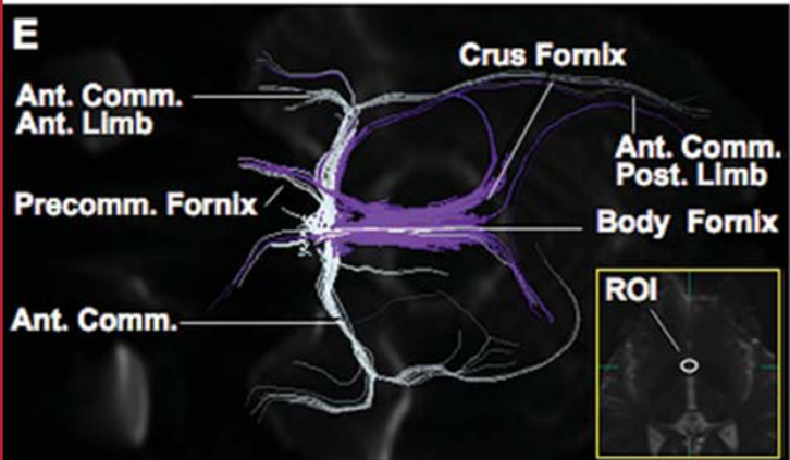 Simultaneous tractographic reconstruction of the fornix and anterior commissure. Precommisural and postcommisural forniceal fibers (magenta) pass around the anterior commissure (white), which bifurcates in an anterior and posterior limb. The inset shows the location of the ROI (white) used for the reconstruction of the anterior commissure.