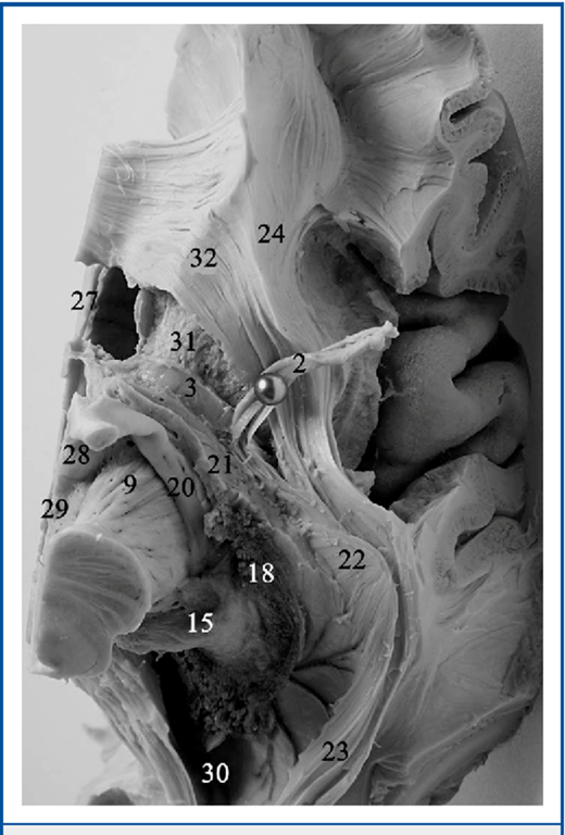 Inferior view of the left hemisphere. 2, lateral (temporal) limb of the anterior commissure; 3, canal of Gratiolet; 9, pes pedunculi; 15, pulvinar; 18, choroid plexus; 20, optic tract; 21, ansa peduncularis; 22, the Meyer loop; 23, anterior part of optic radiation; 24, uncinate fasciculus; 27, septum pellucidum; 28, mammillary body; 29, posterior perforating substance; 30, atrium of the lateral ventricle; 31, caudatolenticular bridges; 32, ventral callosal radiations of Peltier.