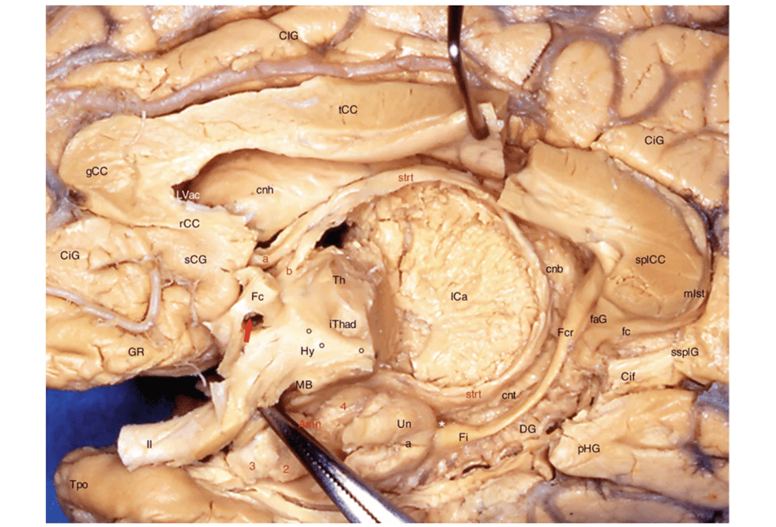 Medial aspect of the right cerebral hemisphere, showing the rostral division of the stria terminalis: Amn: Amygdaloid nuclear complex, 2: Baso-lateral, 3: Baso-medial, 4: Cortical, CiG: Cingulate gyrus, cnb: Caudate nucleus body, cnh: Caudate nucleus head, cnt: Caudate nucleus tail, DG: Dentate gyrus, faG: Fasciolaris gyrus, Fc: Column of fornix, fc: Fasciola cinerea, Fcr: Crus of the fornix, Fi: Fimbria, gCC: Genu of the corpus callosum, GR: Gyrus rectus, sCG: Subcallosum gyrus, ssplG: Subplenial gyrus, Hy: Hypothalamus, ICa: Internal capsule, iThad: Interthalamic adhesion, Lvac: Lateral ventricle anterior cornu, MB: Mamillary body, mlst: Medial longitudinal stria, pHG: Parahippocampal gyrus, rCC: Rostrum of the corpus callosum, splCC: Splenium of the corpus callosum, ssplG: Subsplenial gyrus, strt: Stria terminalis, a: Ending fasciculus (supra-commissural component) destinated to the paraterminalis gyrus and to the accumbens and septal nuclei, b: Other ending fasciculus (hypothalamic component) destinated to the anterior commissure, the fornix and the hypothalamus), tCC: Truncus of the corpus callosum, Th: Thalamus, Tpo: Temporal pole, Un: a uncal apex, II: Optic nerve. Red arrow: It shows the commissural component of strt entering the Gratiolet’s canal (the anterior commissure has been removed in order to see the fibres of this commissural component). Little black circles: Hypothalamic sulcus. White asterisk: Velum terminale of Aeby. The posterior portion of the diencephalon has been widely removed in order to show very well the stria terminalis. It is the same for the fornix's body. The rostral part of the septum pellucidum is tracted up by a little retractor. A forceps pulls lightly the hypothalamus's floor.