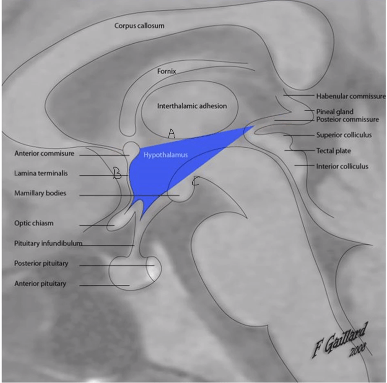 Triangle: A: Anterior Commissure-Posterior Commissure line, B: Anterior commissure - Chiasm, C: Chiasm to Posterior commissure