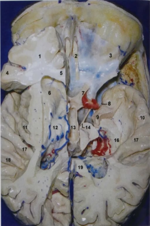 The brain has been sliced coronally at the optic chiasm, and both thalami along with the basal ganglia have been removed through the choroidal fissure to display the overall location of the mesial temporal structures in relation to the rest of the brain