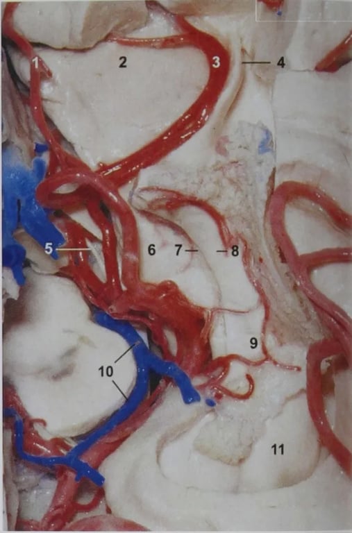 A cut more caudal into the mid brain level hence cant see the PCA and Pcom