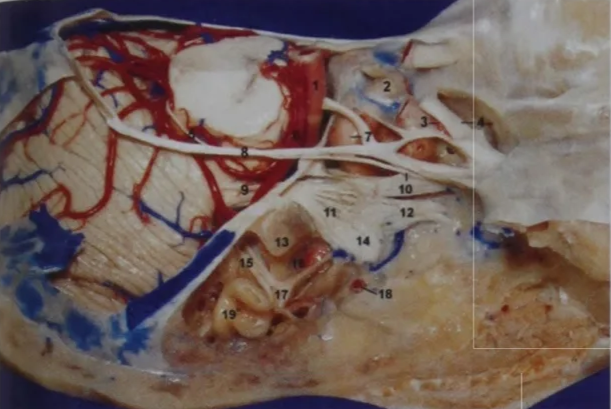 Lateral view of the right cavernous sinus; the lateral wall of the cavernous sinus has been peeled off to display the contents of the cavernous sinus. The anterior clinoid process and the tentorium have been removed as well. The part of the mesial temporal lobe that is located below the tentorial groove is related to the cavernous sinus.