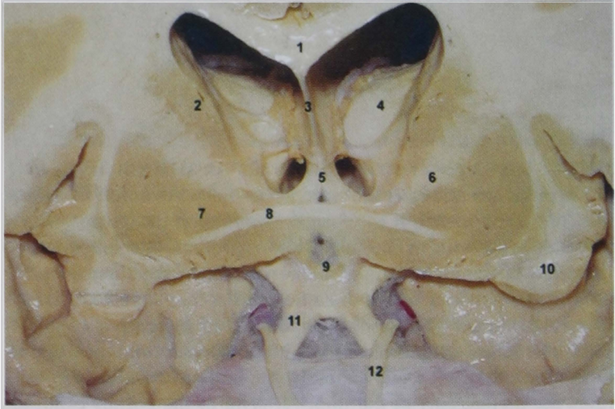 Coronal cut has been performed at the level of the optic chiasm