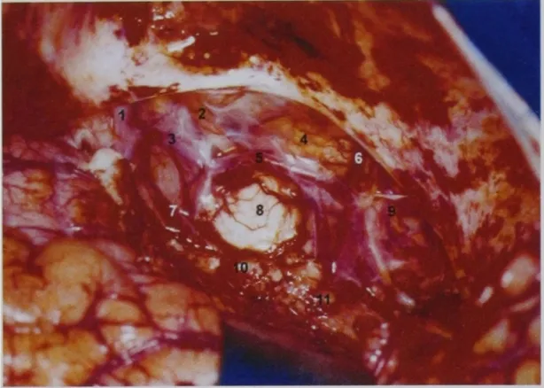 Surgical view of the contents of the crural and the ambient cisterns after the right temporal lobectomy and the amygdalohippocampectomy.