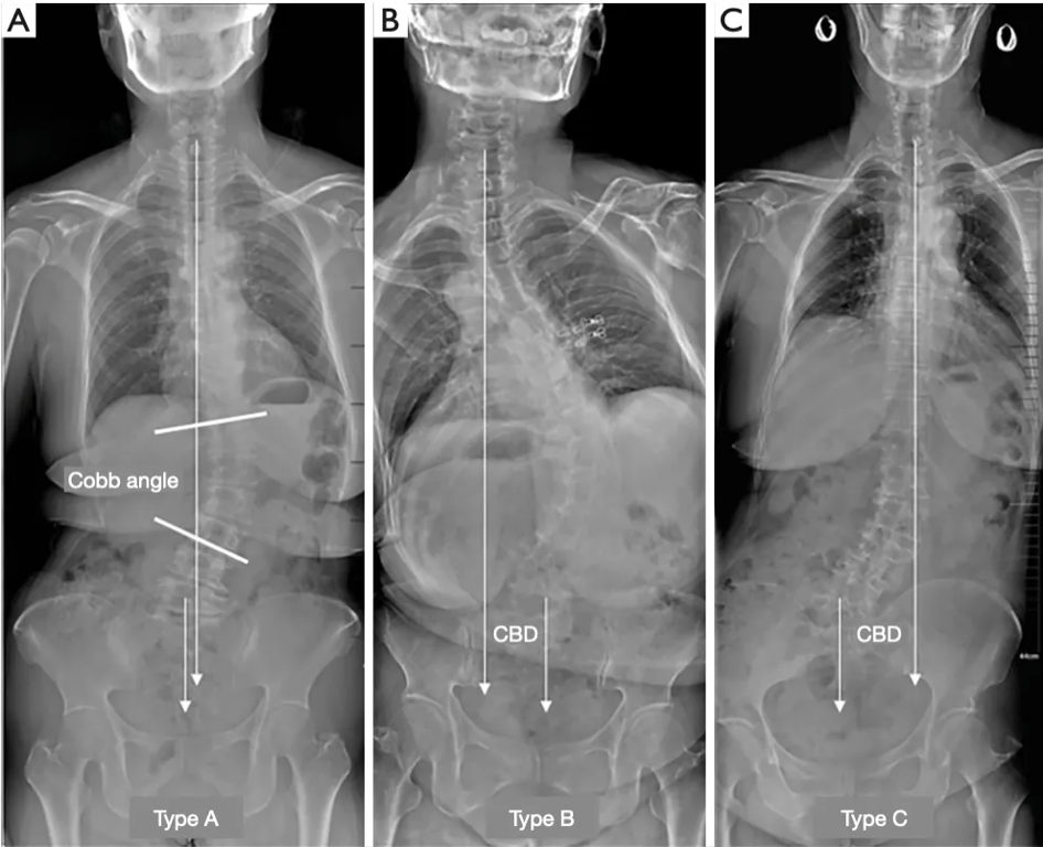 CBD, coronal balance distance.