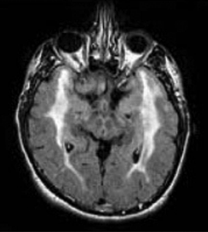 FLAIR MRI of the brain showing hyperintensities involving the temporal poles in a patient with cerebral autosomal dominant arteriopathy with subcortical infarcts and leukoencephalopathy (CADASIL).