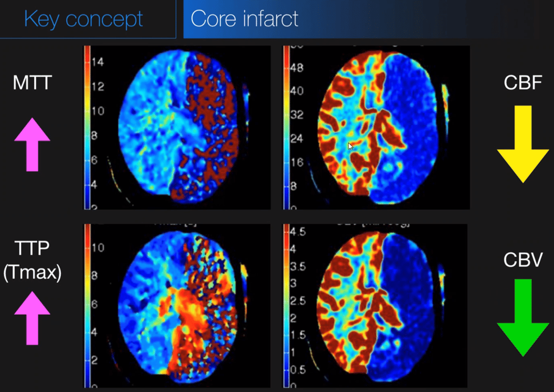 An area with prolonged MTT or Tmax, markedly decreased CBF and markedly reduced CBV