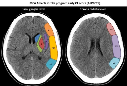 C: Caudate; IC: Internal capsule; L: Lentiform nucleus; I: Insular Cortex. 