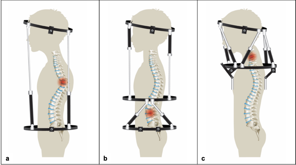 Halo-external fixator frame positioning: a) thoracic deformity; b) lumbar deformity; c) cervical deformity