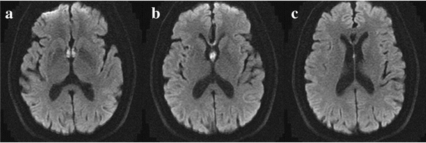 DWI MRI axial slides from caudal to cranial showing diffusion restriction in both columns of the fornix and the left side of the genu of the corpus callosum