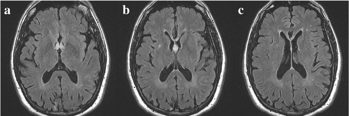 FLAIR MRI axial slides from caudal to cranial showing edematous swollen, hyperintensive both columns of the fornix and the left side of the genu of the corpus callosum