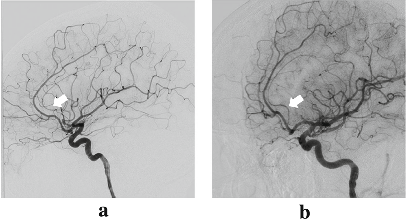 DSA of a left ICA injection. a Lateral view and b oblique view show the small-sized but visible ScA (arrows) originating from the AcoA complex