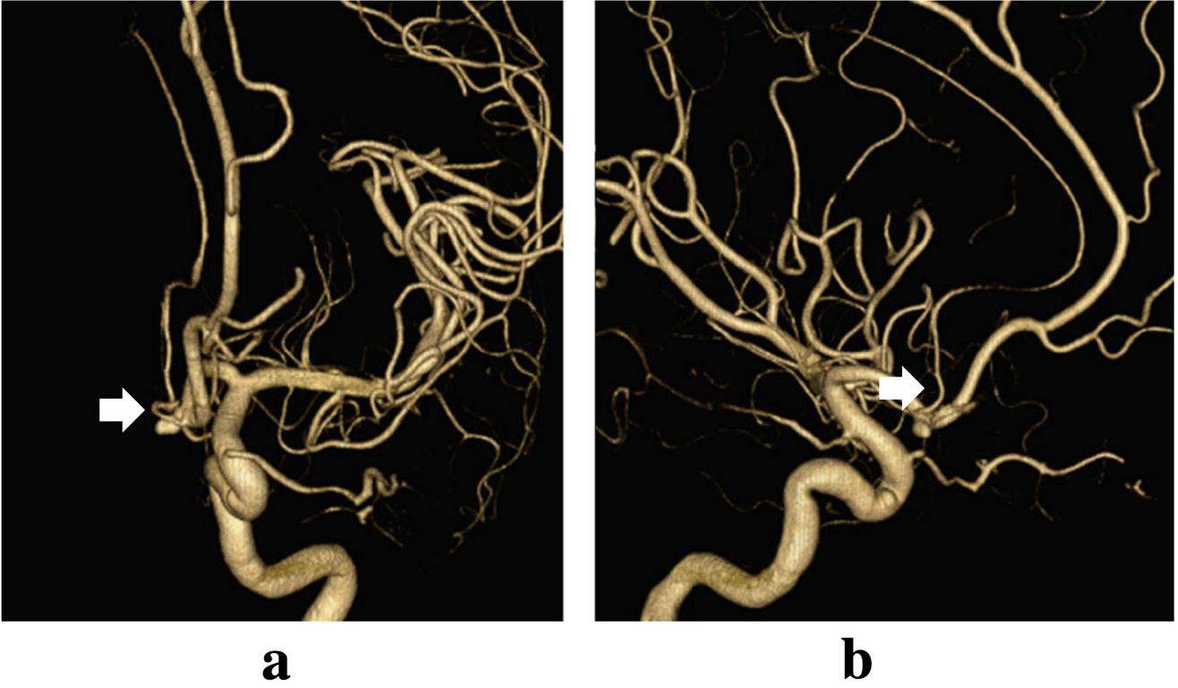 3D rotational angiography ap and lateral projection allowing a better visualization of the typical course of the ScA (arrows) ending in this particular case in the median callosal artery. Note the proximity of the ScA origin to the AcoA aneurysm