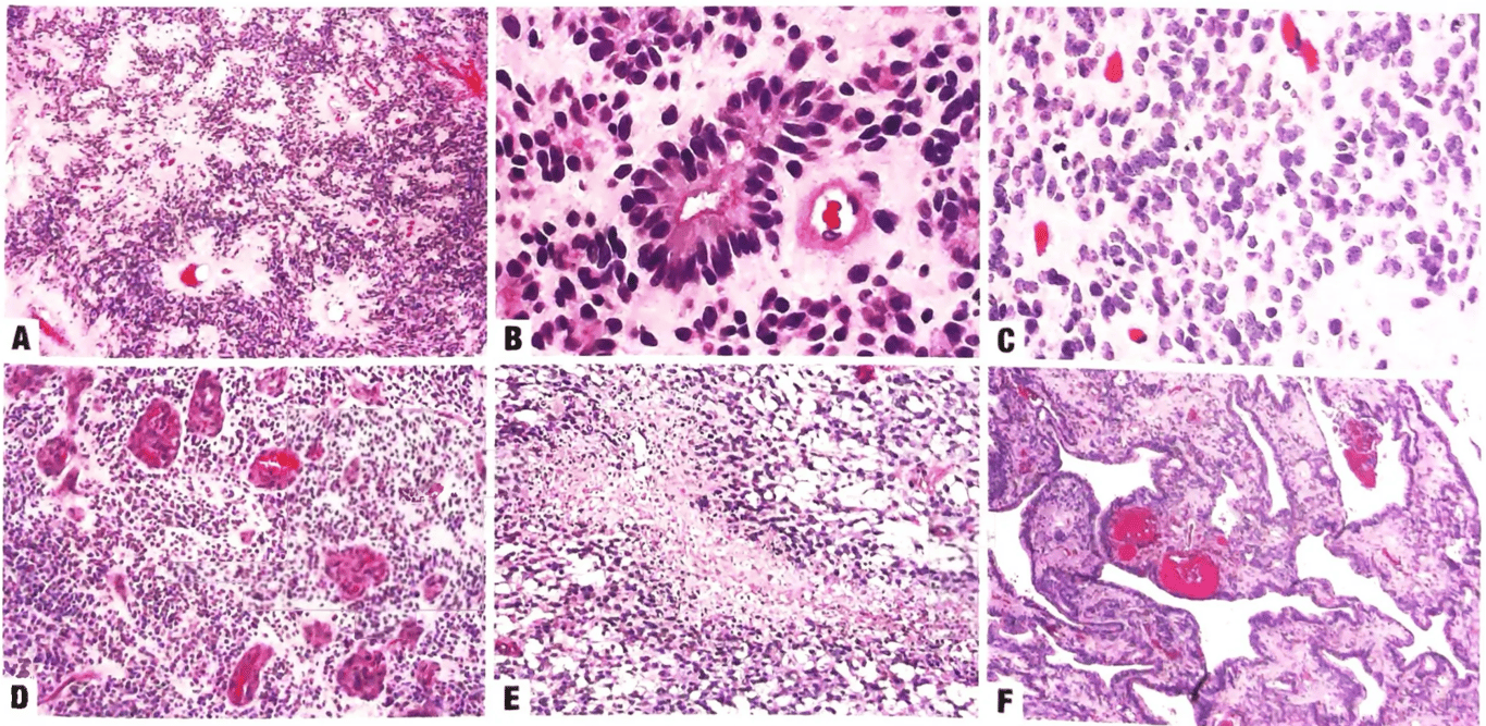 Posterior fossa ependymoma.  