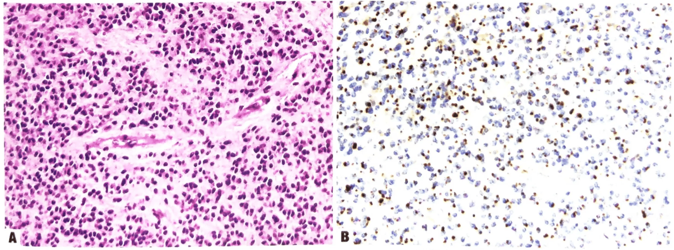 Supratentorial ependymoma, YAP1 fusion-positive. A, Small, slightly angulated nuclei set against a fibrillary matrix. B, Typical widespread and strong dot-like EMA immunoreactivity. 