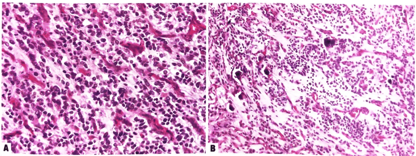 Supratentorial ependymoma, ZFTA fusion-positive. Tumour cells with round nuclei set in a fibrillary matrix. Branching capillary blood vessels (A) or branching blood vessels and dystrophic calcification (B) can be seen.