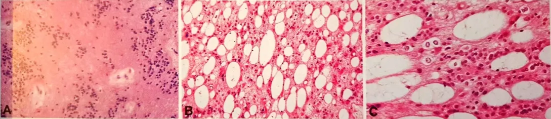Subependymoma. A, Subependymomas have a coarse fibrillar matrix and contain clusters of uniform nuclei. B, Microcysts are common. C, Cells are uniform, often appearing as bare nuclei against the fibrillary matrix. 