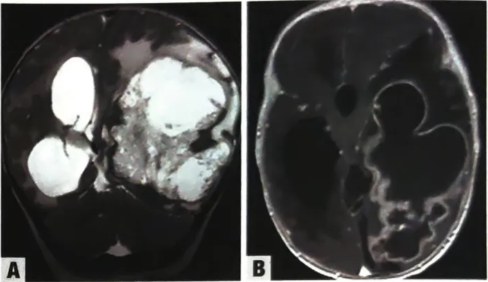 Supratentorial ependymoma, YAP1 fusion-positive. A, T2-weighted coronal MRI showing a large cystic tumour. B, Ependymoma with YAP1::MAMLD1 fusion. T1-weighted axial MRI showing a large cystic tumour with contrast enhancement of solid tumour parts. 
