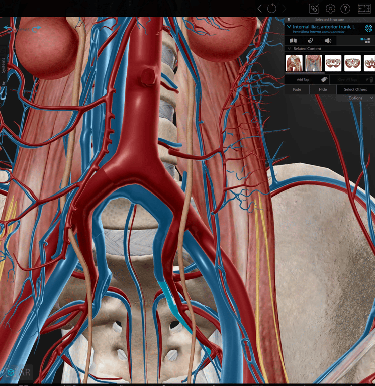 The ureter, left common iliac artery branching into the internal and external iliac artery. The same for the common iliac vein. can also see the left Genitofemoral nerve over the Psoas. The median sacral vein and artery is also present. Behind the internal iliac vein there is a branch of vein called the iliolumbar veins which can also be present during the retroperitoneal dissection.  