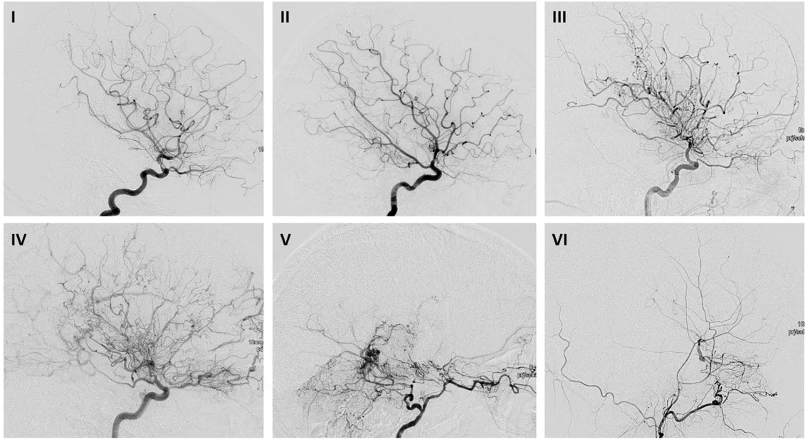 DSA images with lateral views of patients with MMD of ICA (I–V) and ECA (VI). 
(I) Suzuki’s Stage I: narrowing of carotid fork. 
(II) Suzuki’s Stage II: initiation of basal moyamoya, ACA and ACM are dilated. 
(III) Suzuki’s Stage III: intensification of moyamoya, remarkable moyamoya vessels at the base of the brain, MCA and ACA can be occluded. 
(IV) Suzuki’s Stage IV: minimization of basal moyamoya, more and more transdural anastomoses occur, next to MCA and ACA the PCA can be affected. 
(V) Suzuki’s Stage V: even more reduction of basal moyamoya vessels, intracerebral anastomoses between ACP and ACM occur prominent. 
(VI) Suzuki’s Stage VI: vascularisation of ACA and MCA exclusively through transdural anastomosis of ACE and basilar/vertebral arteries