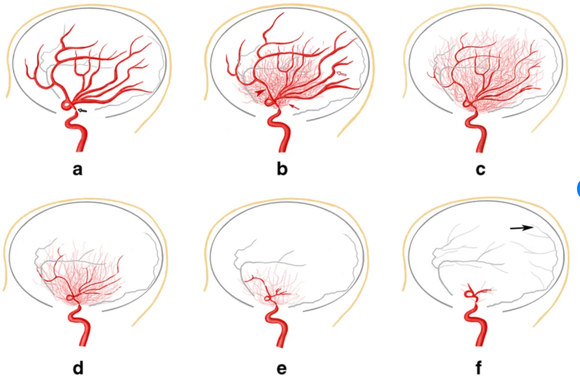 Schematic diagram of the six stages of MMD according to the Suzuki staging system (the red vessel represents the internal carotid artery system and the gray vessel represents the meningeal branches from the extracranial artery). 
a Stage 1: narrowing begins at the fork of the carotid artery (the narrowed part is pointed by the hollow arrow). 
b Stage 2: initiation of moyamoya collaterals (the red triangle shows the narrow parts of intracranial arteries, the small red arrow shows the moyamoya collaterals around the narrowed vessels and the hollow red arrow shows the distal branch dilatation of the middle cerebral artery and anterior cerebral artery). 
c Stage 3: aggravation of moyamoya collaterals around the narrowed vessels. 
d Stage 4: exacerbation of the narrowed vessels, and the moyamoya collaterals begin to fade. 
e Stage 5: large vessels occlusion and more obvious reduction of surrounding moyamoya changes. 
f Stage 6: disappearance of moyamoya collaterals and internal carotid artery system vessels, instead, the territories of the internal carotid artery are supplied from the external carotid artery (the black arrow shows the collaterals from the extracranial artery)