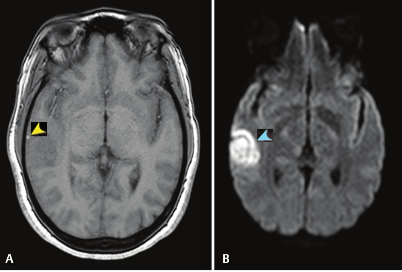 A: T1 axial showing hyperintense vein sign (yellow arrowhead).
B: DWI showing venous infarct (blue arrowhead) adjacent to the thrombosed vein.