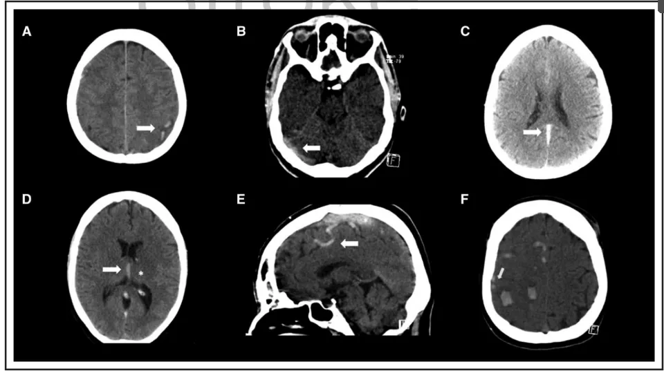 A, Left-sided juxtacortical C-shaped hemorrhages. 
B, Transverse sinus thrombosis. 
C, Straight sinus thrombosis. 
D, Internal cerebral vein thrombosis (arrow) and left thalamic hypodensity (*). 
E, Cord sign (arrow) and hyperdense sagittal sinus thrombosis (*). 
F, Multiple small hemorrhages in same patient as in E. Arrows indicate cord sign.