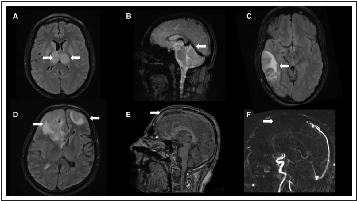 Typical findings of cerebral venous thrombosis on magnetic resonance imaging.
A, Bilateral thalamic hyperintensity (arrows) on fluid-attenuated inversion recovery (FLAIR) in a patient with deep cerebral vein thrombosis. 
B, Susceptibility-weighted imaging shows hypointensity of the straight sinus (arrow), vein of Galen, and internal cerebral veins. 
C, Venous infarction due to transverse sinus thrombosis with heterogeneous FLAIR hyperintensity (arrow). 
D, Bilateral FLAIR hyperintensities (arrows) with mass effect in a patient with superior sagittal sinus thrombosis (arrow), shown in E on a contrast-enhanced T1 sequence and in F absent venous filling defect (arrow) with phase-contrast magnetic resonance venography.