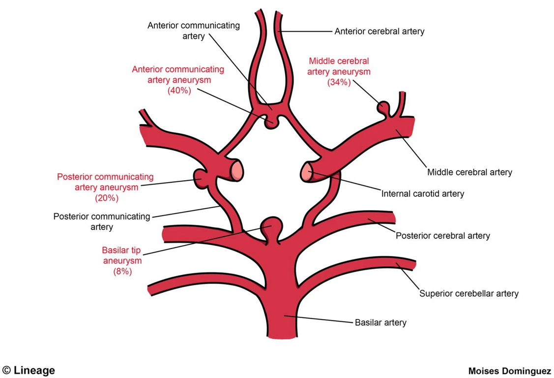Saccular (Berry) Aneuryms of the Circle of Willis