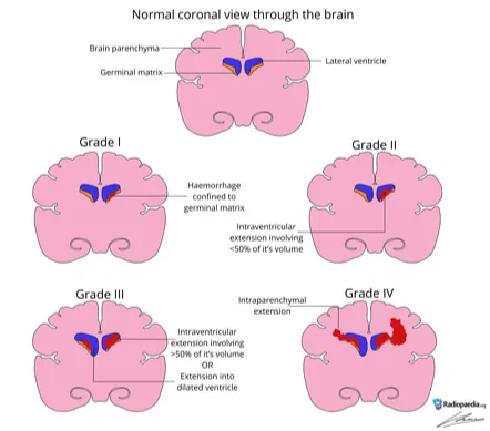 Germinal matrix haemorrhage