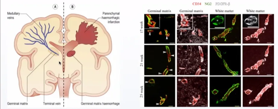 Germinal matrix - macroscopic and microscopic anatomy