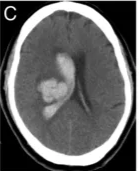 Subcortical white matter