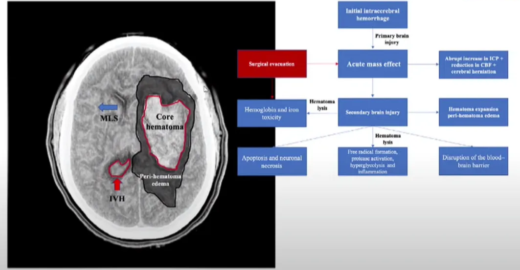 Secondary brain injury after ICH