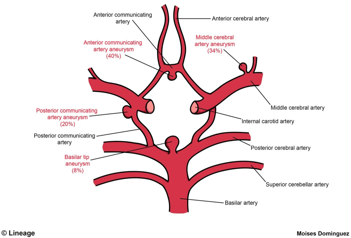 Saccular (Berry) Aneuryms of the Circle of Willis