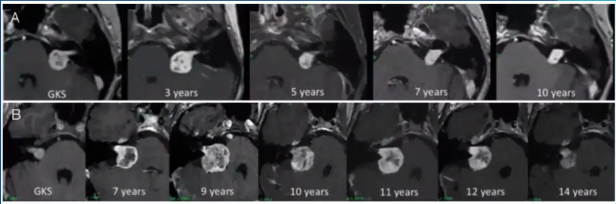 Pseudoprogression after SRS