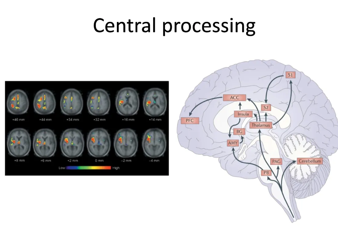 Sensitization through NMDA receptor through C fibres
The neurons can develop changes to the pain → can be permanent forming chronic pain
Phantom limb pain: Spinal anaesthetic used during procedure to reduce central sensitization
