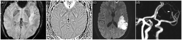 acute left MCA stroke. SWI image (a) and phase image (b) demonstrates a thrombus in the superior M2 division of the left MCA, which is a CT equivalent of a MCA ‘dot sign’. DWI (c) shows acute left MCA territory infarct. Time-of-flight MRA confirms abrupt vessel occlusion of the distal superior M2 division of the left MCA. MCA: middle cerebral artery; SWI: susceptibility weighted imaging; CT: computed tomography; DWI: diffusion-weighted imaging; MRA: magnetic resonance angiography.