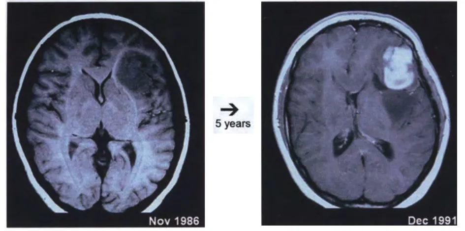 These MRIs show the typical progression of a frontotemporal IDH1-mutant diffuse astrocytoma (left) to an IDH1-mutant secondary glioblastoma (right) over a period of 5 years {1533}. Note the absence of central necrosis.