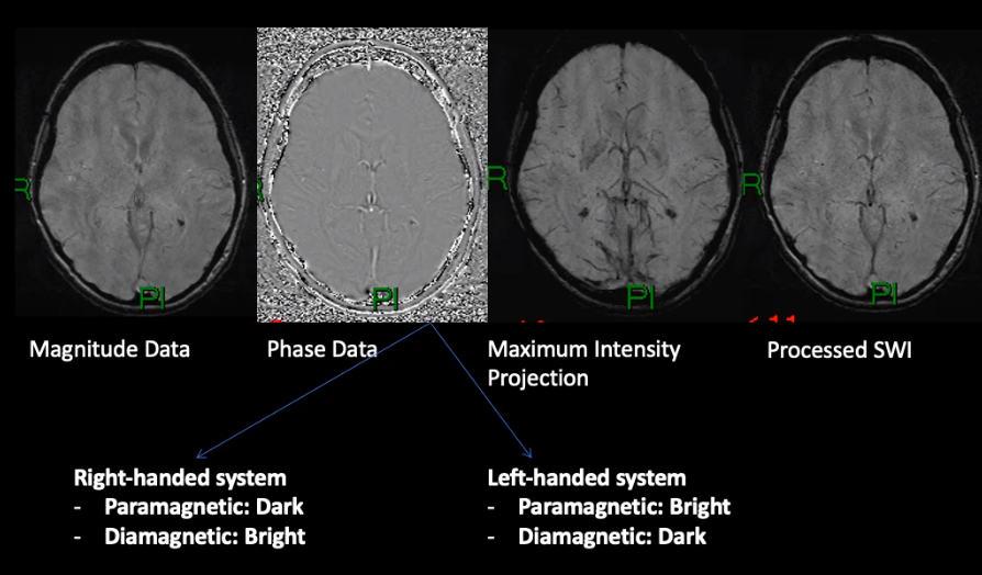 Left handed system: Siemen
Right handed system: GE/Philips