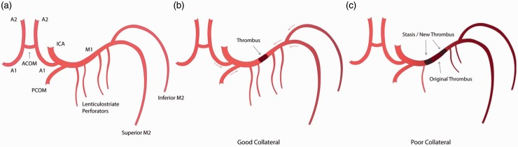 (a) Labeled anatomical illustration of the anterior circulation of the Circle of Willis. (b) and (c) Collateral circulation as a modifiable variable in determining the final length of thromboembolus. (b) A short ‘original’ MCA thromboembolus in a patient with good antegrade and retrograde collateral circulation (red arrows) preventing blood stasis. (c) Conversely, in a patient with poor collateral circulation there is blood stasis on either side of the ‘original' thromboembolus promoting new thrombus formation. MCA: middle cerebral artery.