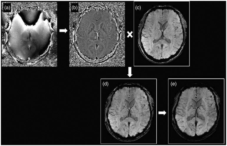 SWI sequence generates two sets of images: raw phase image (a) and magnitude image (c). The raw phase image contains background unwanted low frequency information and requires further high-pass filtering to produce a filtered phase image (b) that is of diagnostic value. The filtered phase image is then converted into a phase mask and combined with the magnitude image to form the final SWI image (d). An additional minimum intensity projection (mIP) image (e) is created by projecting the minimum signal over several slices, usually over four slices. SWI: susceptibility weighted imaging.