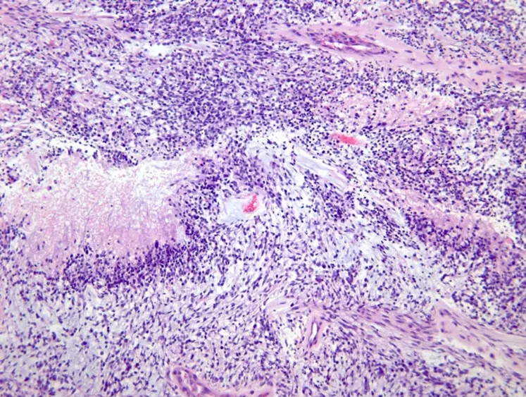 This tumor section demonstrates two common architectural patterns of glioblastoma with areas of high cellularity containing small cells with scant cytoplasm and less cellular areas containing cells with elongated nuclei and abundant fibrillar background; pseudopallisading necrosis is present