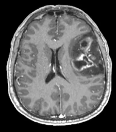 Tl weighted MRI with gadolinium based contrast shows mixed nodular and ring enhancement within the mass