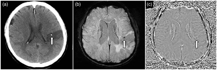 Acute left MCA territory stroke. Non-contrast enhanced CT of the head (a) shows a calcified thromboembolus (arrow) in the M4 cortical branch of the left MCA. SWI image (b) depicts the calcified thromboembolus (arrow) as a hypointense focus, and on the phase image (c) the thromboembolus (arrow) shows negative phase shift and also appears hypointense. (Images acquired on a left-handed MRI system). MCA: middle cerebral artery; CT: computed tomography; SWI: susceptibility weighted imaging.
