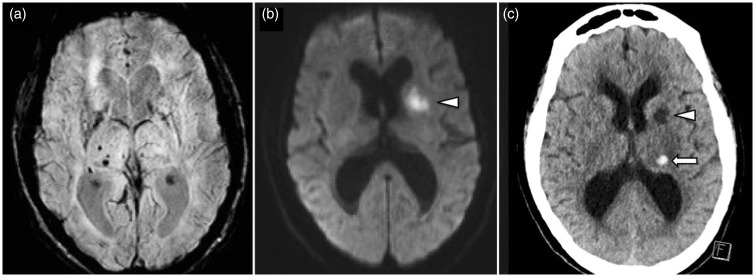 acute left MCA territory stroke. SWI image (a) shows existing hypertensive pattern of cerebral microbleeds in the right basal ganglia. DWI (b) shows acute infarct in the left anterior limb of the internal capsule. Non-contrast CT of the head (c) performed 48 hours after administration of IV-tPA shows a small extra-ischemic zone hematoma in the left thalamus. 